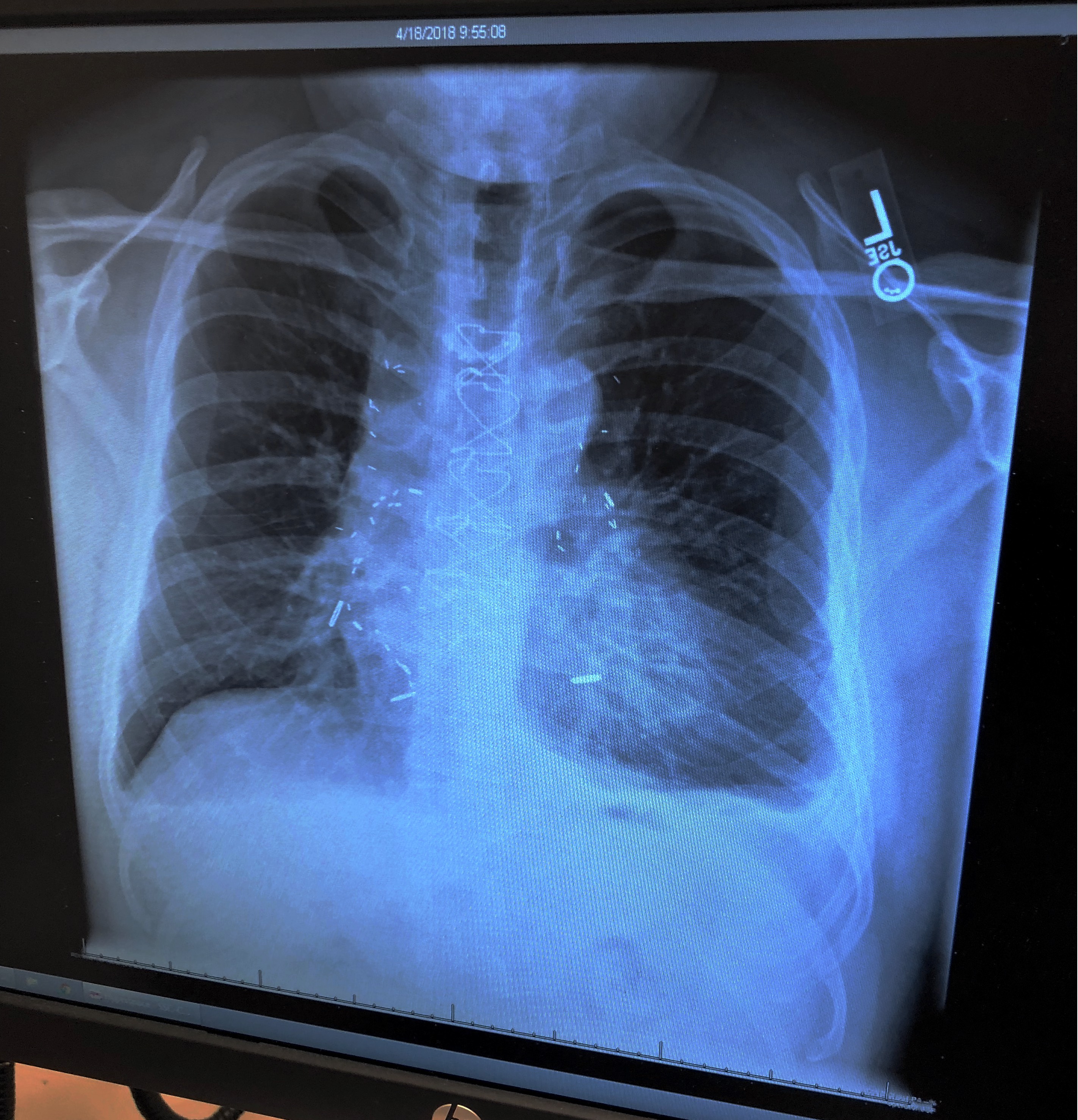 Chest X-Ray